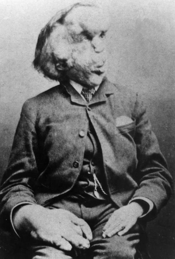 Joseph Merrick ( Elefantmanden ) kendt freak show stjerne fra fortiden