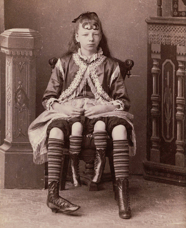 Josephine Myrtle Corbin ( Pigen med fire ben ) - freak show stjerne